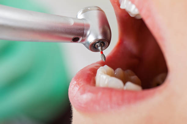 Best Knocked-Out Tooth (Avulsed Tooth) Treatment in North Liberty, IA